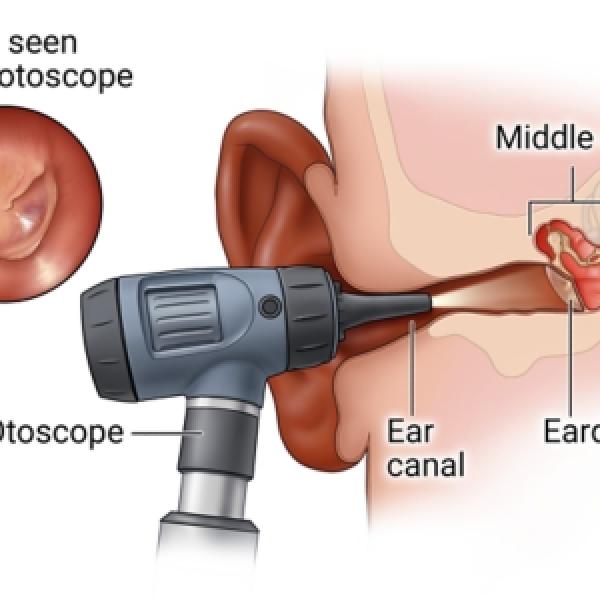 Otoscope